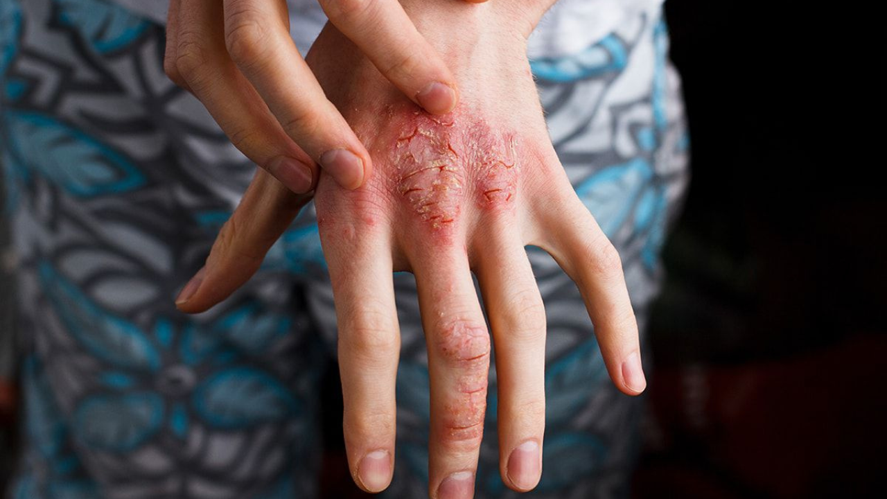 Ziemā atopiskā dermatīta pacientiem āda kļūst īpaši sausa, saplaisājusi un jutīga pret aukstumu