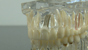 Zobu modelis ar zobu implantu augšžoklī.